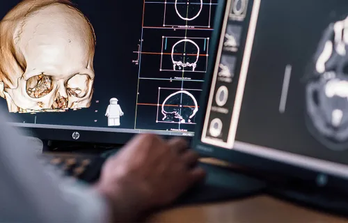 Tekoäly tunnistaa aivoverenvuodot - CGI:n ja HUSin innovaatio syntyi Helsingin yliopistollisessa sairaalassa